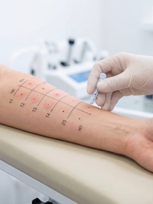 Prueba de alergia realizada en la consulta de la Dra. Susana Varela Losada en Ourense